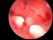 上海和同济医院试管婴儿有哪些步骤呢？