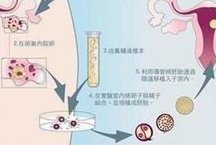 胚胎移植过程需要多久？胚胎移植需要做哪些检查？